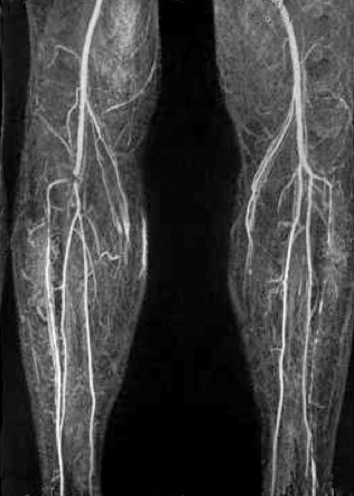 Kraujagyslės x -ray