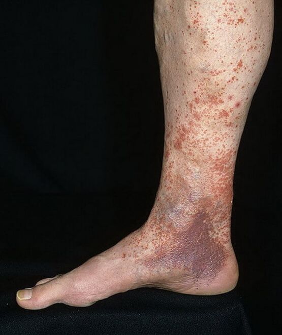 Varikozės dermatitas