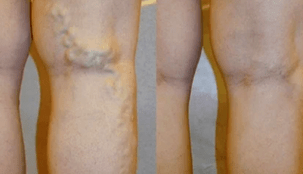 vyrų kojų venų varikozės požymiai ir simptomai
