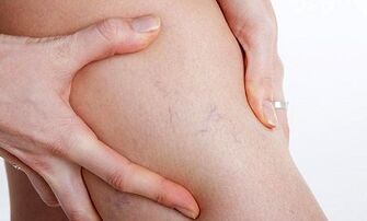 Priežastys, dėl kurių išsivysto kojų venų varikozė