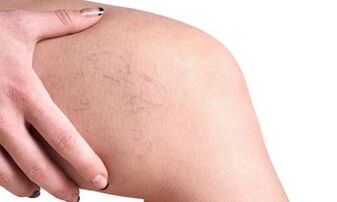 varikozinių venų vystymosi etapai