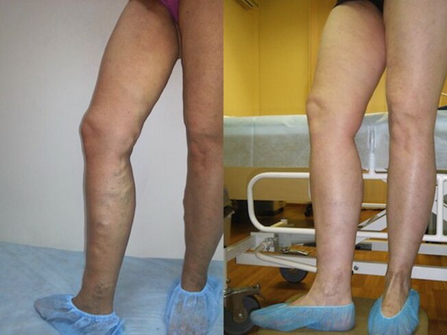 Kojos prieš ir po varikozinių venų gydymo lazeriu