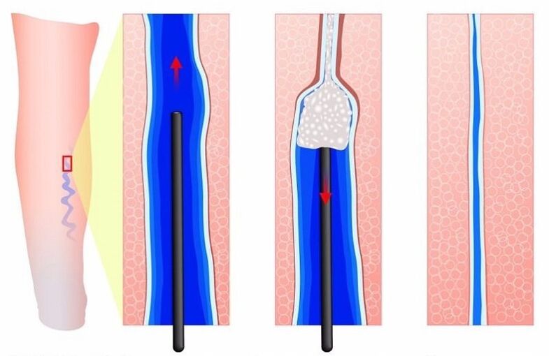 Vyrų kojų venų varikozės skleroterapija